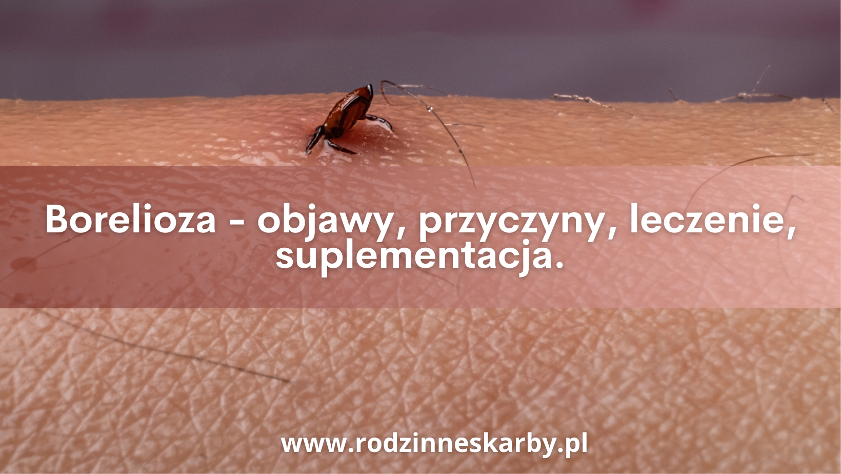 Borelioza – objawy, przyczyny, leczenie, suplementacja