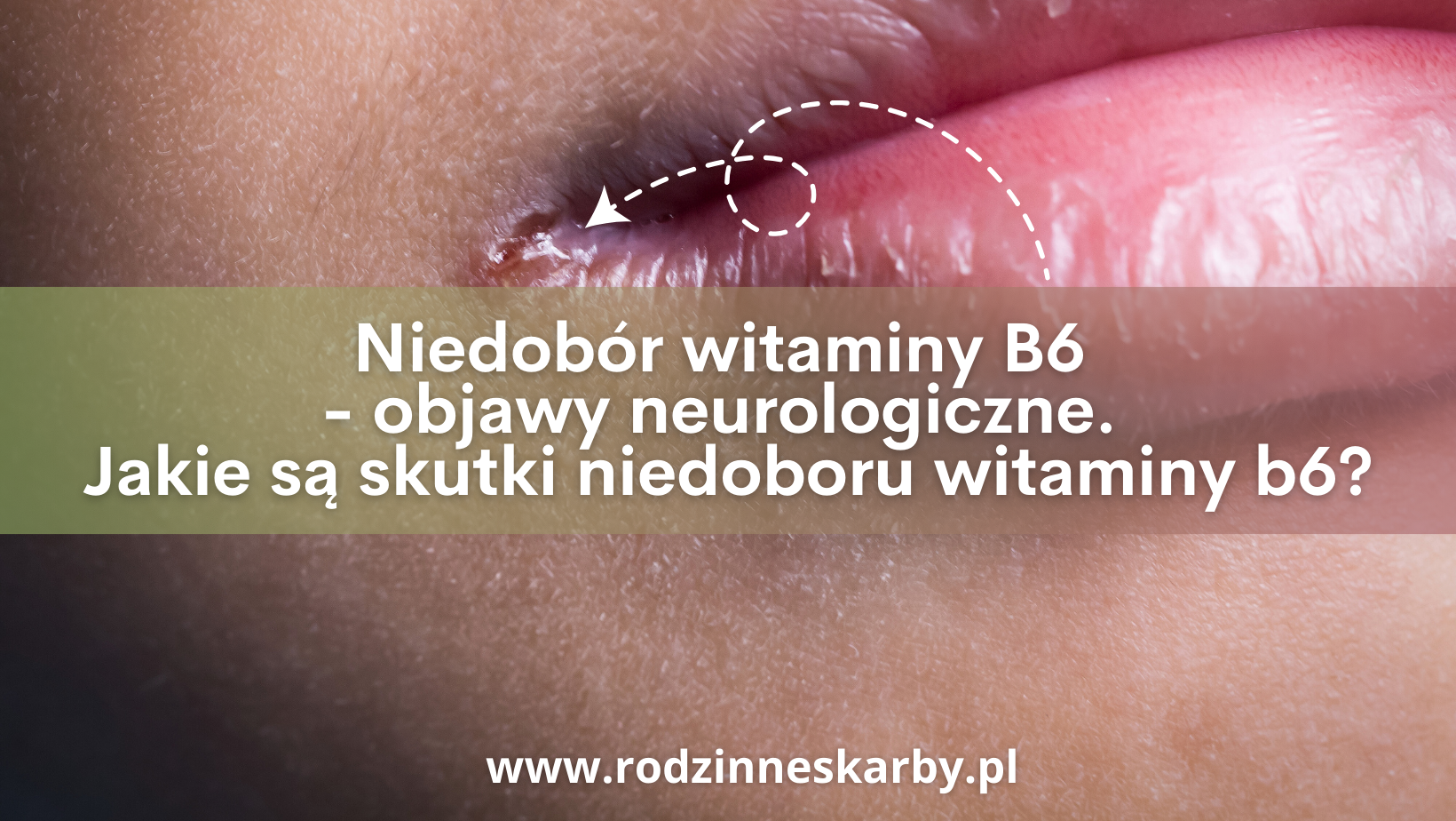 Niedobór witaminy b6 – objawy neurologiczne. Jakie są skutki niedoboru witaminy b6?